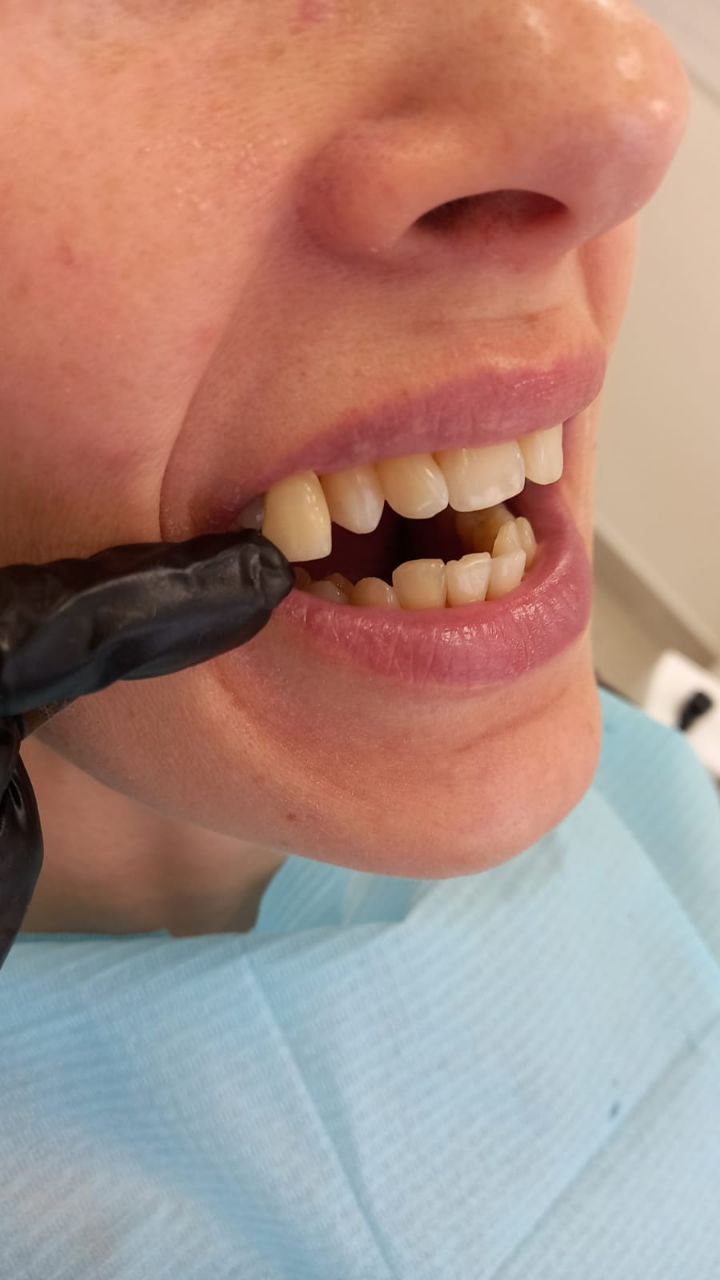 Снятие зубных отложений Томск Писемского Импланты Nobel Biocare Томск Усть-Киргизка 2-я